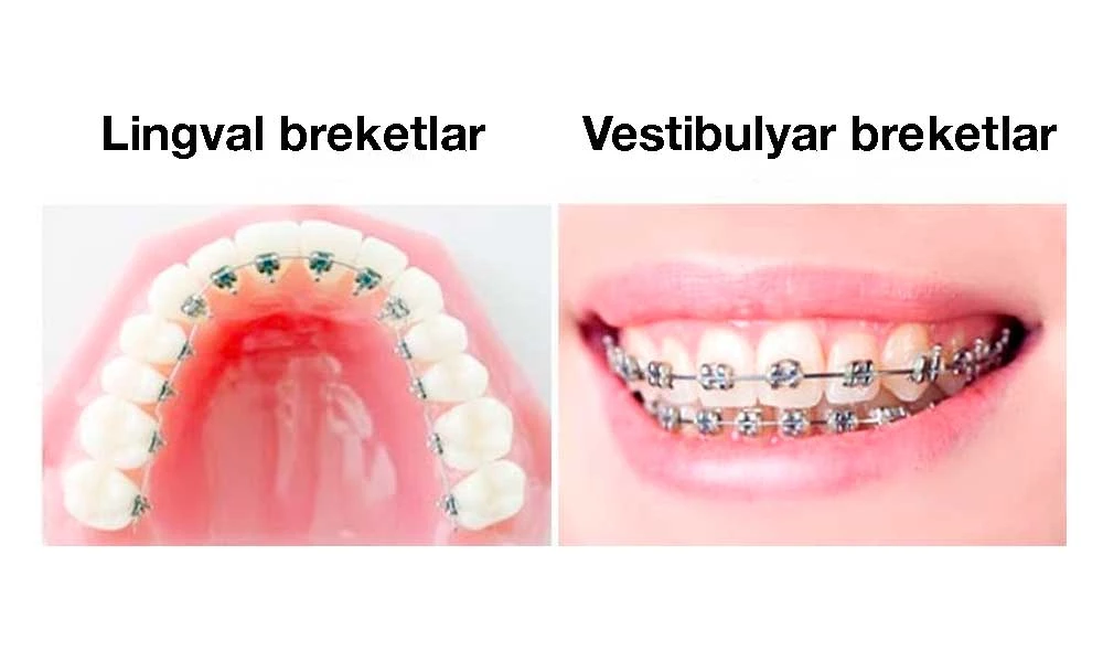 Lingval va Vestibulyar breketlar.